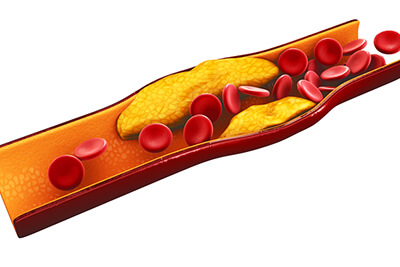 3d Illustration of blood cells with plaque buildup of cholesterol isolated white